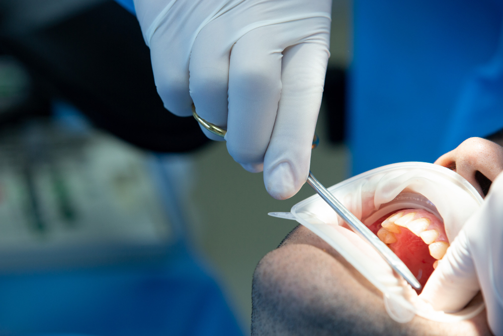 Root Canal Retreatment